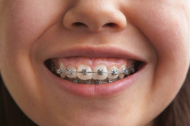 gum disease with braces