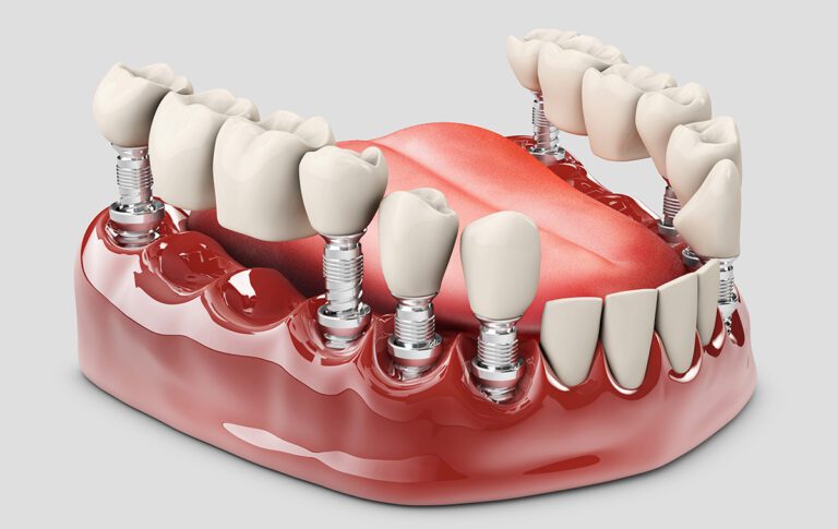 Partial Dentures