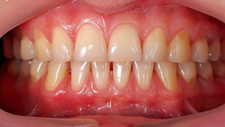 Is Gum Disease Transmittable?